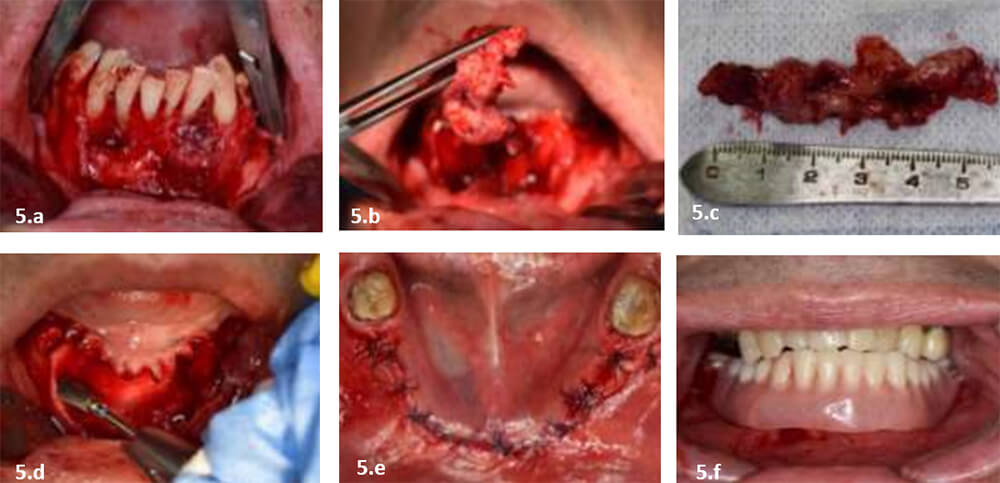 Figura 5. Fotografías trans operatorias, biopsia excisional. a) levantamiento de colgajo de espesor total. b y c) muestra posterior a enucleación. d) osteotomía periférica. e) síntesis de tejidos. f) adaptación de prótesis removible.