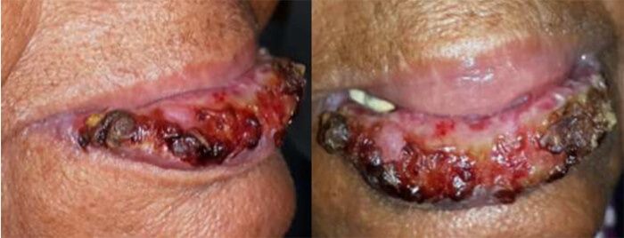 Figura 1. Aspecto clínico de labio inferior. Vista frontal y lateral. Se aprecia el labio cubierto por numerosas costras y seudomembranas amarilentas cubriendo áreas ulceradas.