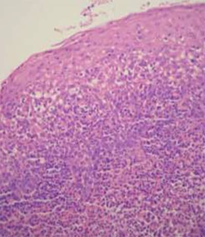 Figura 2. Microfotografía con tinción de H&E a 40x, en la cual puede observarse el epitelio espongiótico y un denso infiltrado inflamatorio subyacente, que se conforma por numerosos eosinófilos, plasmocitos e histiocitos.