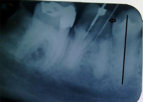 Figura 3. Se señala la distancia entre el reborde marginal de la bicúspide y la lima situada en la perforación, referencia para la hemisección. Esta lima paralela a la situada intraconducto denota la mesioversión del eje longitudinal de la raíz distal respecto al del 45 (línea negra), lo que favorecería las relaciones interproximales de la corona.