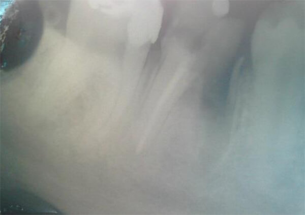 Figura 5. Radiografía para corroborar extracción de la raíz mesial.