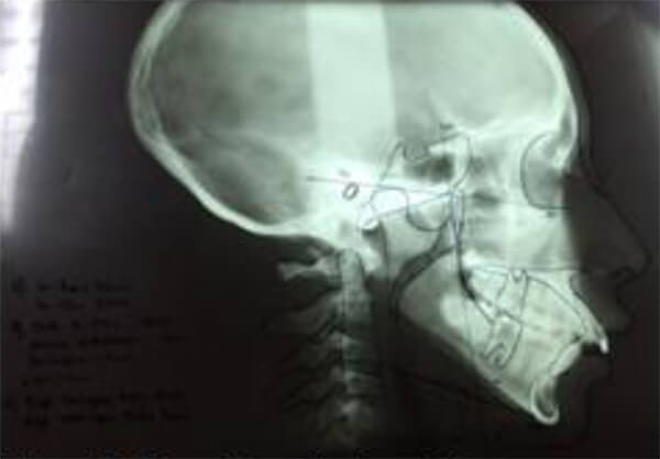 Figura 7: Teleradiografía de perfil con Trazado cefalométrico sobre negatoscopio.
