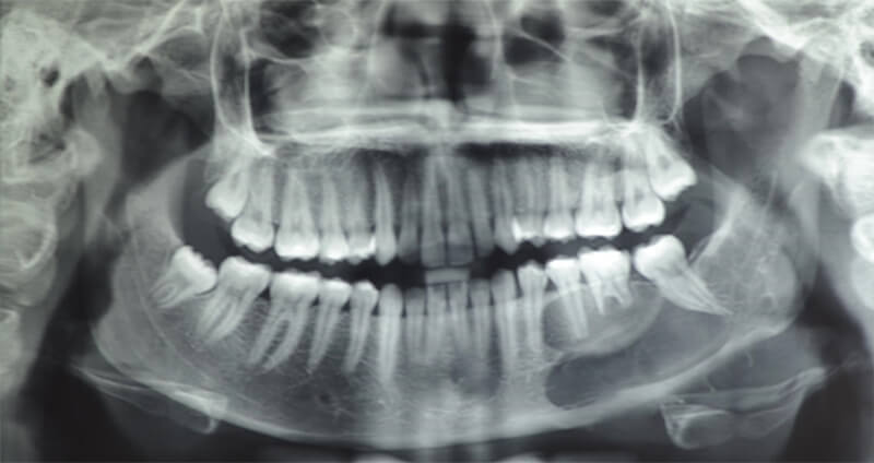 Figura 1. Ortopantomografía donde se evidencia imagen radiolúcida de bordes definidos que involucra cuerpo, ángulo y parte de la rama mandibular izquierda, con rizálisis de OD 35 y 36.