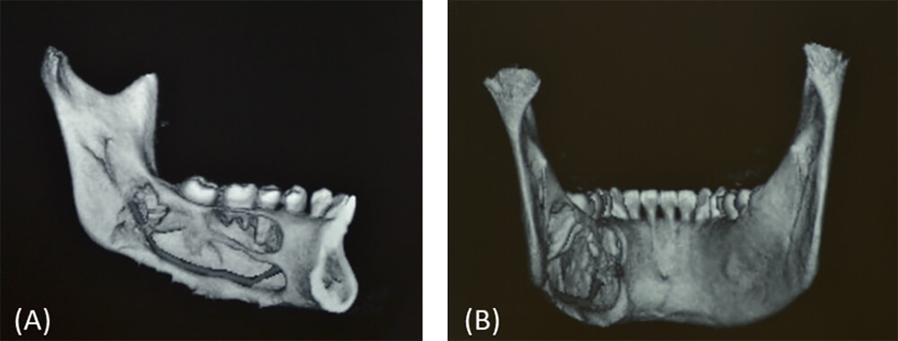 Figura 2. (A) Reconstrucción volumétrica de hemimandíbula izquierda cara medial donde se observa lesión osteolítica que abarca cuerpo y ángulo mandibular e involucra OD 35,36,37. (B). Reconstrucción volumétrica mandibular vista posterior, donde se observa expansión y fenestración de la cortical lingual.