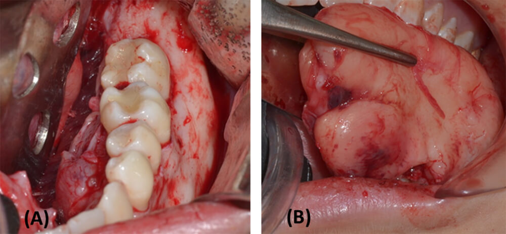 Figura 3. (A) Exposición quirúrgica de la lesión. (B) Enucleación y biopsia excisional de la lesión, nótese la apariencia fibrosa y compacta de la misma.