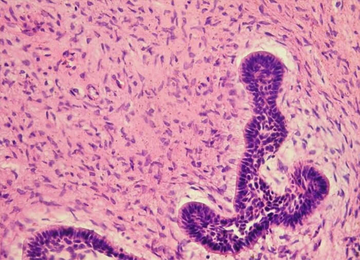 Figura 4. Microfotografía 40x teñido con H&E de FA, conformado por islas de epitelio odontogénico neoplásico y mesénquima proliferativo. 