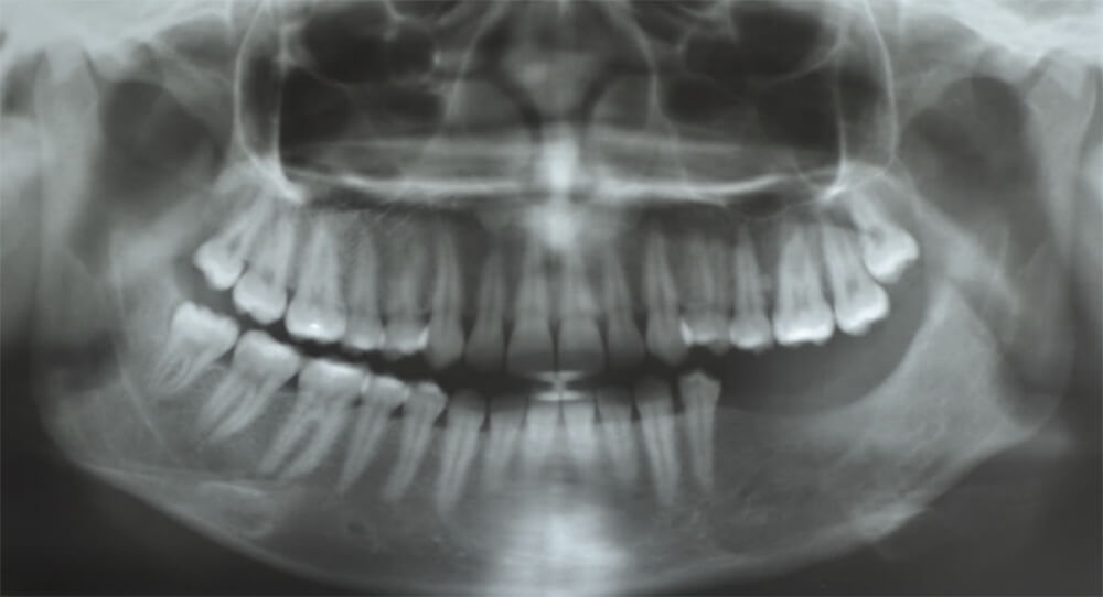 Figura 5. Ortopantomografía a los 2 años de evolución (año 2015), mostrando excelente cicatrización sugerente de ausencia de lesión.