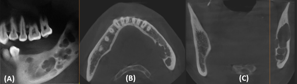 Figura 7. (A) Corte curvo que muestra múltiples imágenes hipodensas, bien delimitadas en cuerpo mandibular izquierdo. (B) Corte axial donde se observan imágenes hipodensas en espesor de cuerpo y ángulo mandibular izquierdo, con fenestración y pérdida de la tabla lingual. (C) Corte coronal con clara evidencia de lesión circunscrita que abarca la totalidad del espesor de la rama mandibular.