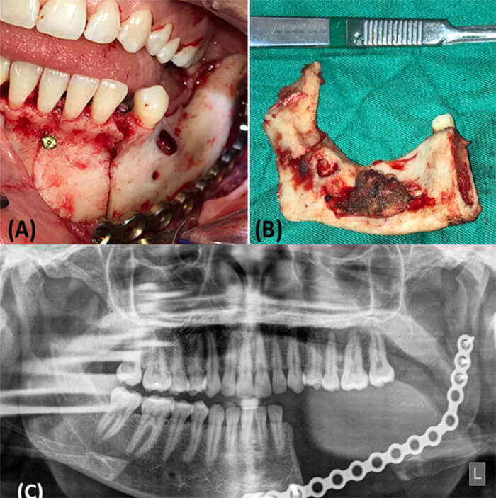 Figura 8. (A) Exposición quirúrgica de la lesión a través de abordaje intraoral. Colocación y fijación de placa de reconstrucción precontorneada. (B) Vista mascroscópica de bloque mandibular.  (C) Ortopantomografía postoperatoria con placa de reconstrucción en posición.