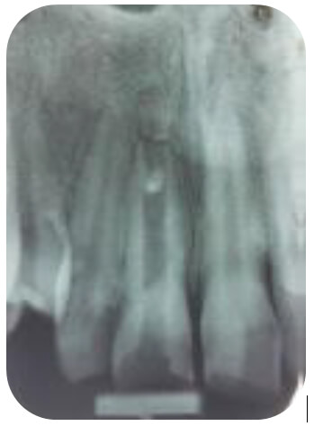 Figura 1. Rx periapical inicial enero 2013. Se observa una imagen radiolúcida (RL) en la corona, que se continua hacia la cámara pulpar y conducto radicular, compatible con pérdida de estructura dentaria y cámara pulpar expuesta al medio bucal. Rizogénesis incompleta e imagen radiopaca (RO) dentro del tercio apical del conducto compatible con un material RO.