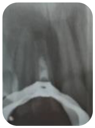 Figura2. Rx periapical operatoria febrero 2013. Se observa imagen RO en el tercio cervical y medio del conducto, compatible con material de obturación (MTA) y se continua con el conducto RL en su totalidad y amplio, rizogénesis incompleta e imagen RL circunscrita en el periápice.