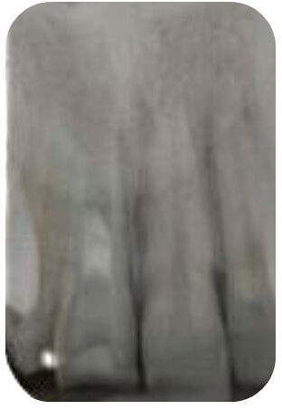Figura 3. Rx periapical de control a los 23 meses (enero 2015) de realizado el procedimiento de revascularización pulpar. Muestra una imagen RO a nivel del tercio cervical y medio del conducto, compatible con material de obturación (MTA) por debajo se ésta se observa un ligero tramado RO, similar a tejido óseo, que se continua con el hueso maxilar.