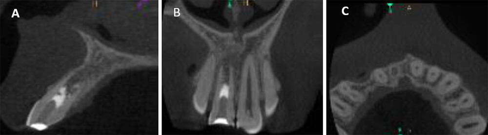 Figura 4. Las imágenes de la THC a los 24 meses (febrero 2015) con un corte de orientación oblicua. Se muestran los 3 planos: sagital (A), coronal (B) y axial (C). Se esclarece la formación de un tejido de aspecto óseo en el interior del conducto. 