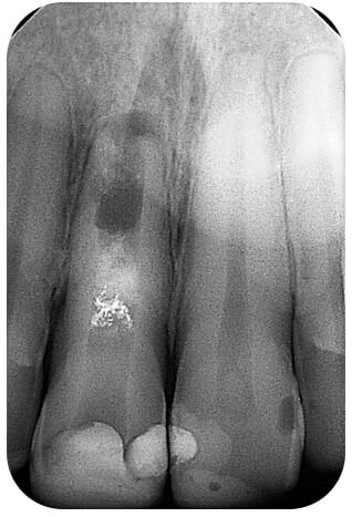 Figura 6. Rx periapical de control a los 8 años (marzo 2021). El 1.1 continua asintomático y funcional; en la imagen radiográfica se observa la corona clínica y la cámara de acceso con dos distintas radiopacidades, compatibles con el material de restauración y la base cavitaria. En el tercio cervical y medio de la raíz, se aprecia una imagen de RO intensa similar a compuesto metálico que en anteriores controles no se evidenciaba, justo por encima de la imagen RO compatible con la barrera de MTA. Debajo de ésta, se aprecia la imagen RL correspondiente al conducto radicular que se continua en su tercio apical con un tramado RO. El ápice radicular conserva la forma achatada. Nótese, la delgada línea RL alrededor de toda la raíz compatible con el espacio del ligamento periodontal, incluso en torno al ápice radicular. Completa cicatrización del hueso perirradicular.