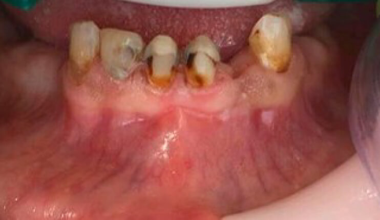 Figura 2. Dientes inferiores, vista vestibular demostrando lesiones no cariosas: erosión y pigmentación extrínseca característica del uso de crack, postratamiento realizado.