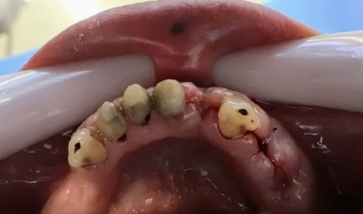 Figura 3. Dientes inferiores, vista lingual demostrando lesiones no cariosas: erosión y pigmentación extrínseca característica del uso de crack, postratamiento realizado