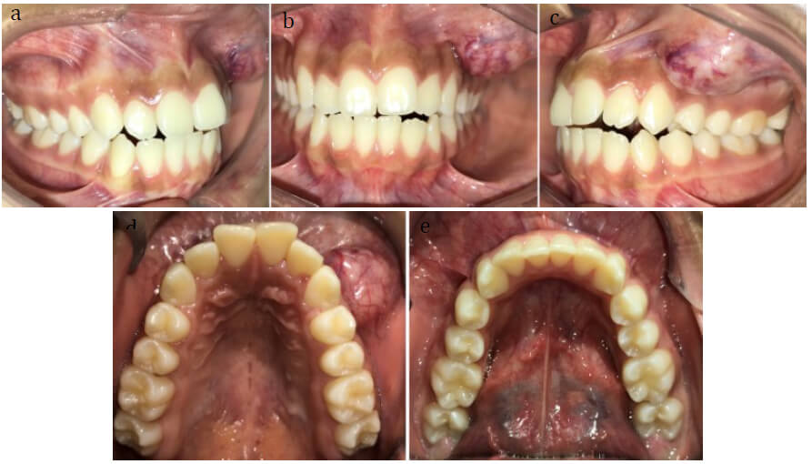 Figura 1: Fotografías intrabucales. (a)lado derecho, (b)frontal, (c)lado izquierdo, (d)oclusal superior y (e)oclusal inferior. Se observa lesión nodular en mucosa labial lado izquierdo del maxilar.