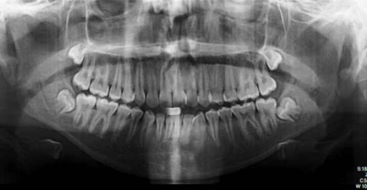 Figura 2: Radiografía panorámica.