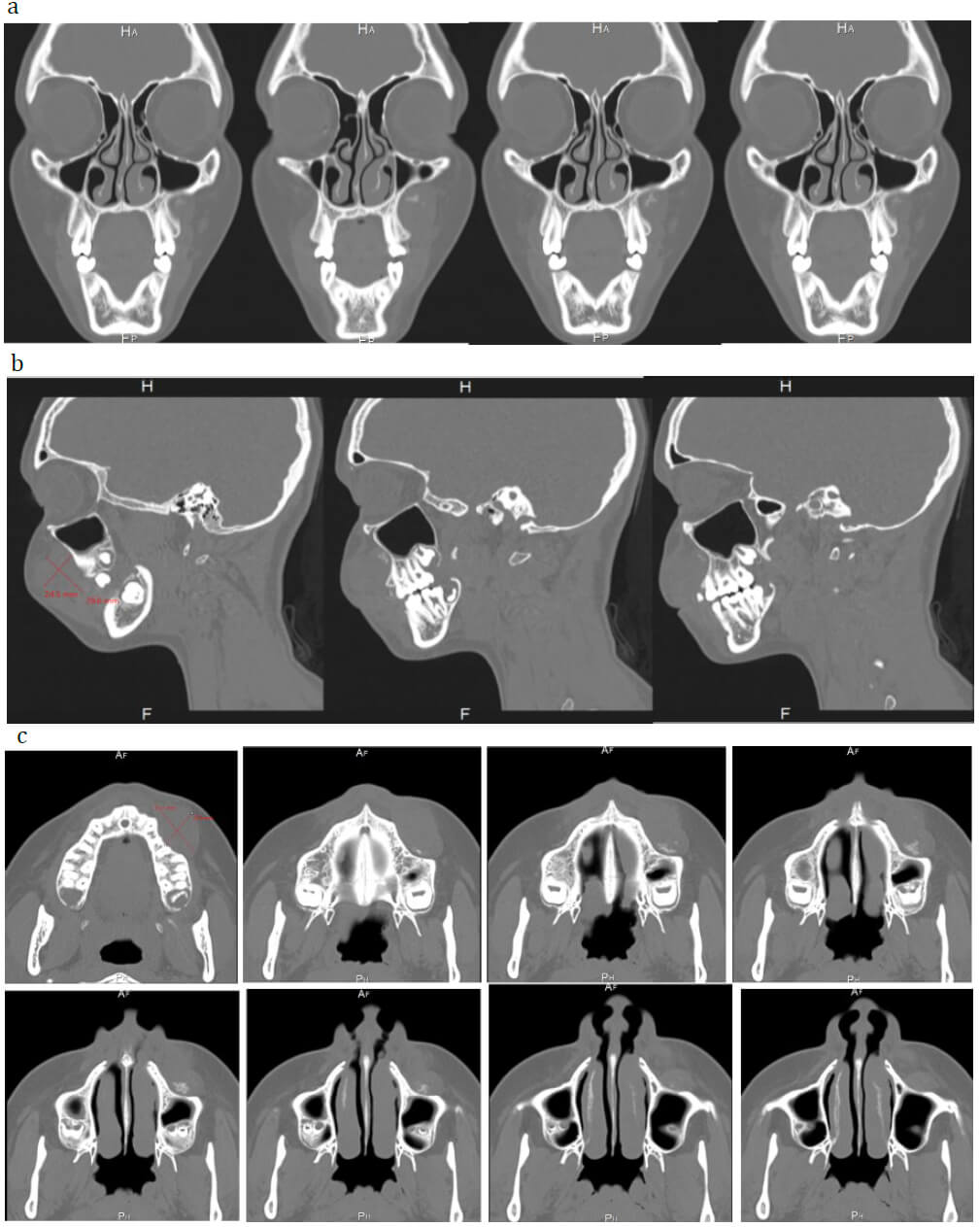 Figura 3: Tomografía computarizada. (a)corte coronal, (b)corte sagital, (c)corte axial.