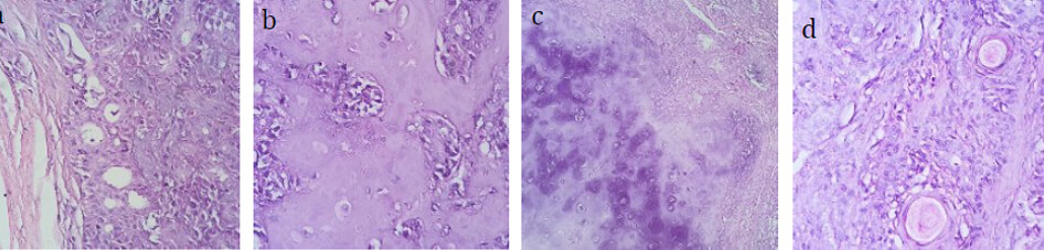 Figura 5: Cortes Histopatológicos (a)cápsula de tejido fibroso y formación de estructuras ductales, (b) tejido osteoide, (c) tejido condroide, (d) formación de perlas de queratina entre las células neoplásicas glandulares.