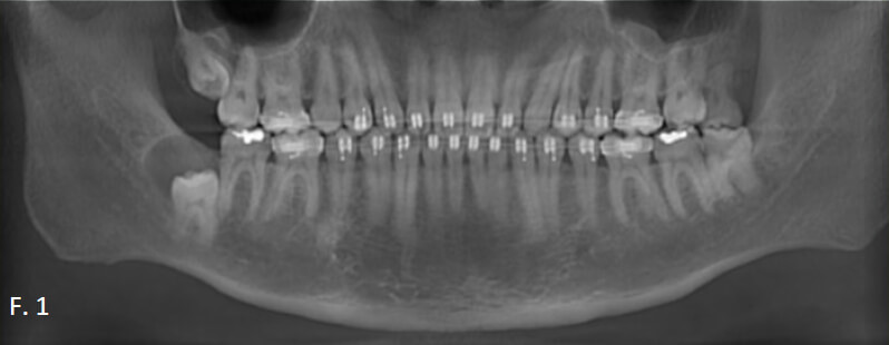 Figura 1. Ortopantomografía; se evidencia unidad es dentaria s retenidas, y otras en oclusión; ubicada según Pell y Gregory, 18 III B, 28 I A, 38 III A.