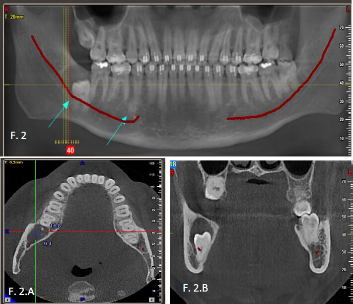 Figura 2 . Tomografía volumétrica; se evidencia: v entana de tejido duro con cortes axial ( A )), coronal ( B )), de la u nidad dentaria 48 con imagen hipodensa, circunscrita, de halo definido, compatible con p é rdida de hueso trabecular.