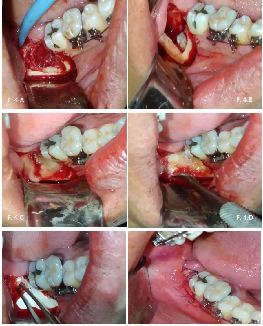 Figura 4. Previa incisión triangular, se realiza desperiostización, ostectomía. Se evidencia un fragmento de Tejido Blando, de color grisáceo, de forma irregular, de consistencia blanda. Se realiza osteotomía, luxación, odontosección, y avulsión dentaria. Material de relleno matriz ósea porcina más plasma acelular. Malla de PRF resultante, malla de fibrina, finalmente se realiza rafia con polipropileno 5-0 (F.4.A, B, C, D, E, F).