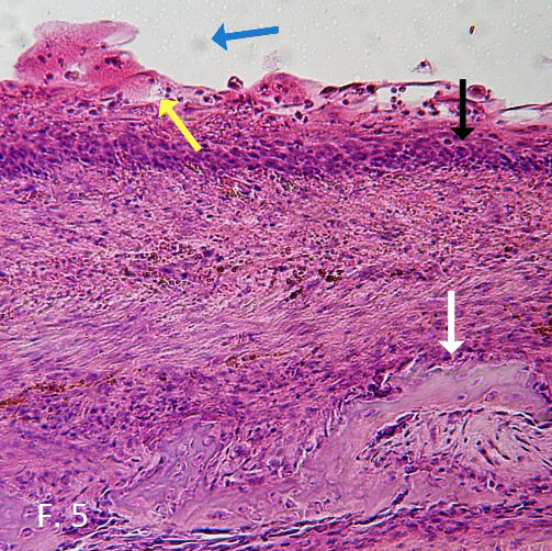 Figura 5. Conclusión diagnostica: quiste dentígero. Flecha azul: cavidad quística, flecha amarilla y negro: Epitelio de revestimiento del quiste, similar al del reducido del esmalte, flecha blanca: cápsula quística.