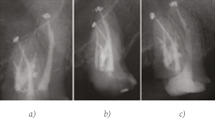 Figura 5. Rx final orto (a), distorradial (b) y rx de reevaluación a 18 meses de control (c).