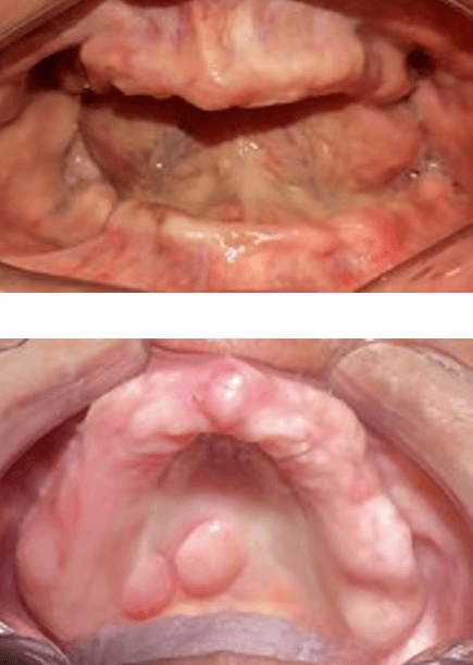Figuras 2 y 3. Examen clínico intrabucal.