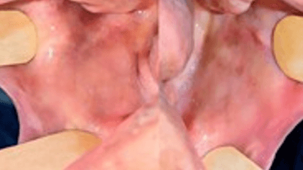 Figura 4. Examen clínico intraoral, mucosa yugal de carrillos.