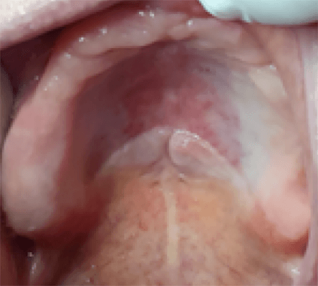 Figura 1. Imagen clínica del maxilar superior y dos lesiones de aspecto tumoral ubicadas en tercio posterior del paladar duro a ambos lados de la línea media.