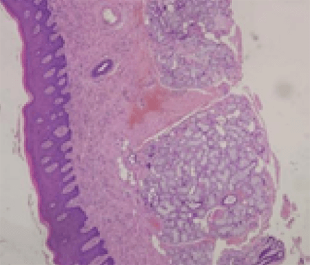 Figura 5. Epitelio plano estratificado con hiperplasia epitelial. El tejido conectivo muestra numerosas glándulas mucosas. H&E x40.
