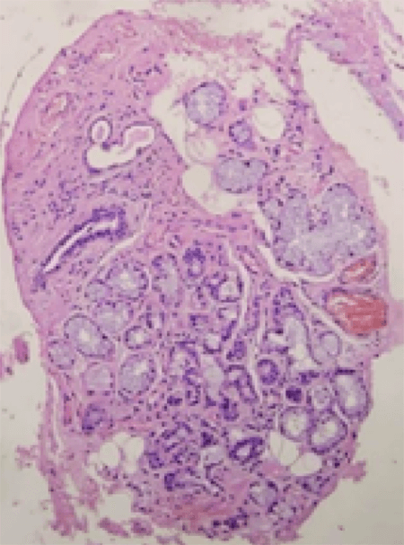 Figura 6. Epitelio plano estratificado con hiperplasia epitelial. El tejido conectivo muestra numerosas glándulas mucosas. H&E x40.