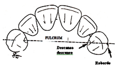 Fig. 3. Modificación del reborde disto-vestibular del canino para la ubicación estética de la barra I.