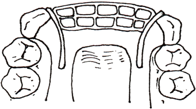Fig. 4. Esquema del retenedor Twin-Flex. El alambre forjado es incluido dentro del conector mayor colado.