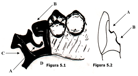 Fig. 5.1 Retenedor Directo A. Brazo retentivo lingual flexible B. Tope en forma de cuña C. Conector menor D. Conector mayor Fig. 5.2 Preparación de la corona del diente pilar A. Descanso B. Socavado retentivo