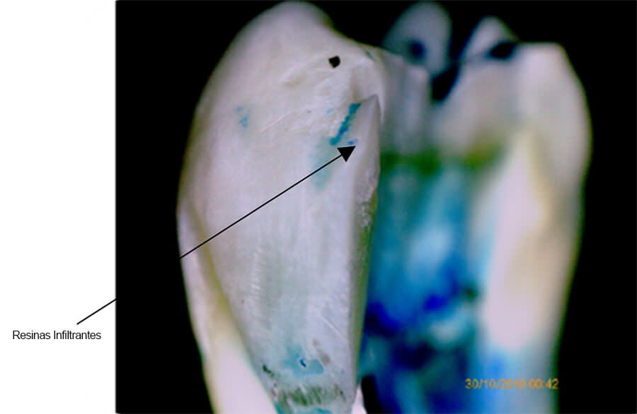 Figura 4 Microfiltración Marginal de las Resinas Infiltrantes, Grado 0. Estereomicroscopia, CIMBUC, Universidad de Carabobo. Fuente: Toledo, Gallegos, López. (2016)