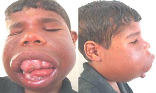 Fig.1 Aspecto frontal denotando la presencia de nevus flammeus, siguiendo toda región inervada por el niervo trigémino (V1/V2/V3) y Vista lateral, aumento de volumen Máxilo-facial, denotando el aspecto de "cara de elefante".