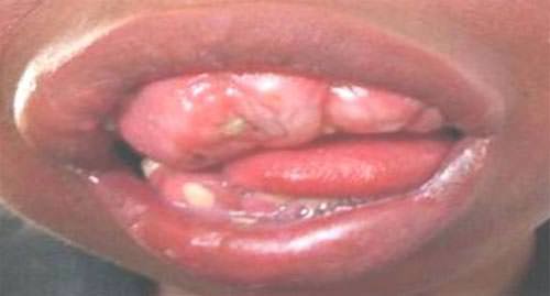Fig.2 Severa hiperplasia de la encía recubriendo las unidades dentales, con intensa sialorreia