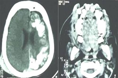 Fig.3 Tomografía computarizada en corte axial, denotando la presencia de displasia micro-venular leptomeníngea y calcificaciones parenquiomatosas y algunas unidades ectópicas dentales..