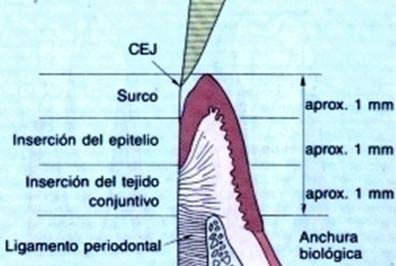 Fig 1 Ancho Biológico. Tomado de Nevins M. Periodontal considerations in prosthodontic treatment. Curr Opin Periodontol. 1993; 151-156.