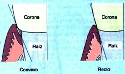 Fig 9 Perfil de Emergencia Tomado de Hagiwara, Y. and Igarashi, T. Emergente profile. Quintessence. 1991; 10(1): 55-64.