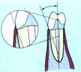 Fig 10a Terminación Engrosada