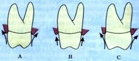Fig 3 Clasificación de Wheeler Tomado de Wheeler, RC. Complete crown form and the periodontium. J. Prosthet Dent.1964; 11:722-734