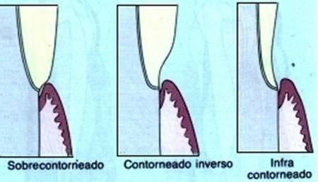 Fig 4 Contornos Tomado de Shigemura Hiroshi. El Contorneado de la corona de prótesis dental. Quintessence.1994; 5(2):65-89.