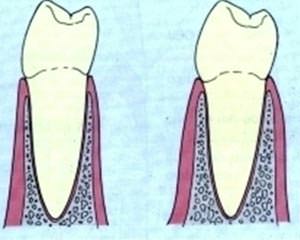 Fig 7 Grosor del Periodonto Tomado de Shigemura Hiroshi. El Contorneado de la corona de prótesis dental. Quintessence.1994; 5(2):65-89.