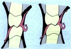 Fig 8 Teoría de Eismann Tomado de .- Eismann, HF et al. Physiologic design criteria for fixed dental restoration. Dent Clin North Am. 1971; 15: 543-568.