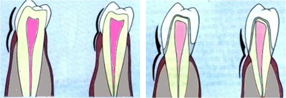 Fig 5 y 6 PROTUBERANCIA DE LA CORONA