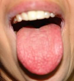 Figura 1 Paciente con Candidiasis atrófica en lengua